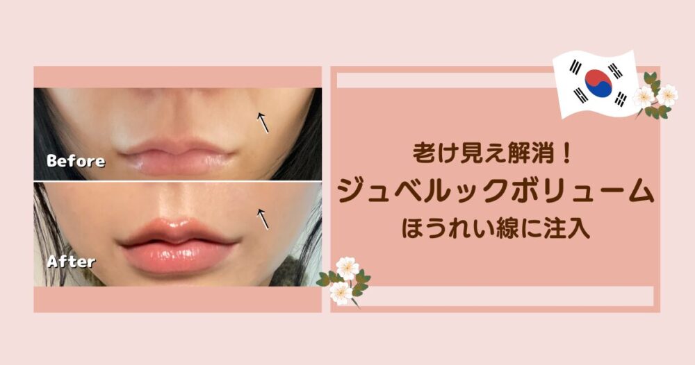 ほうれい線にジュベルックボリュームを打った様子のサムネイル